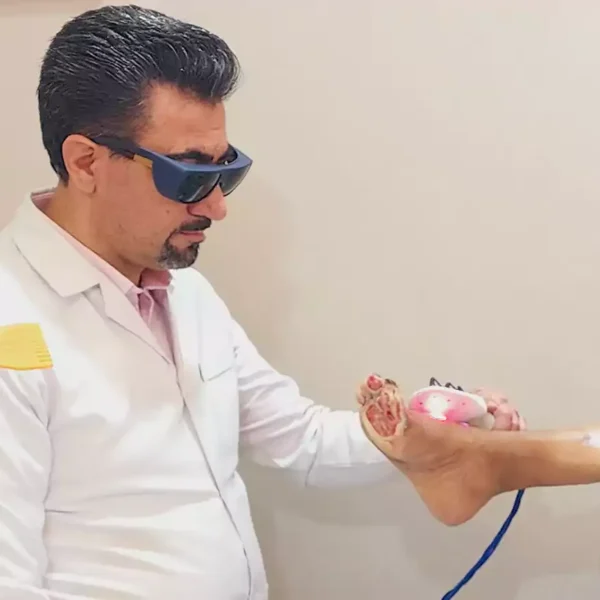laser therapy action لیزر تراپی پای بیمار