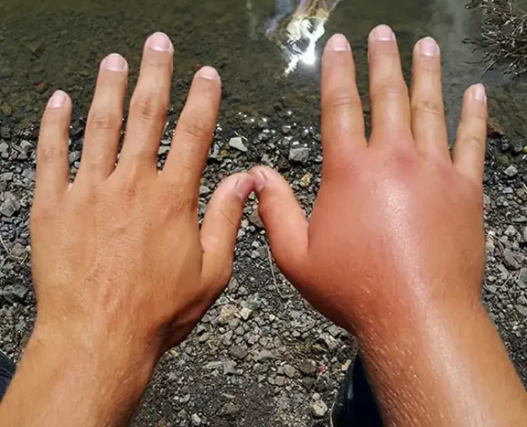 ورم دست بعد از سوختگی