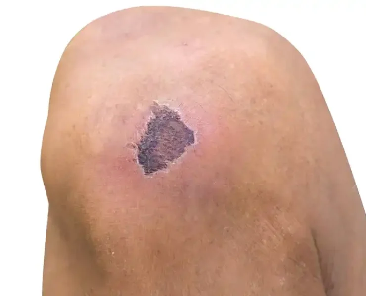 زخم خشک شده