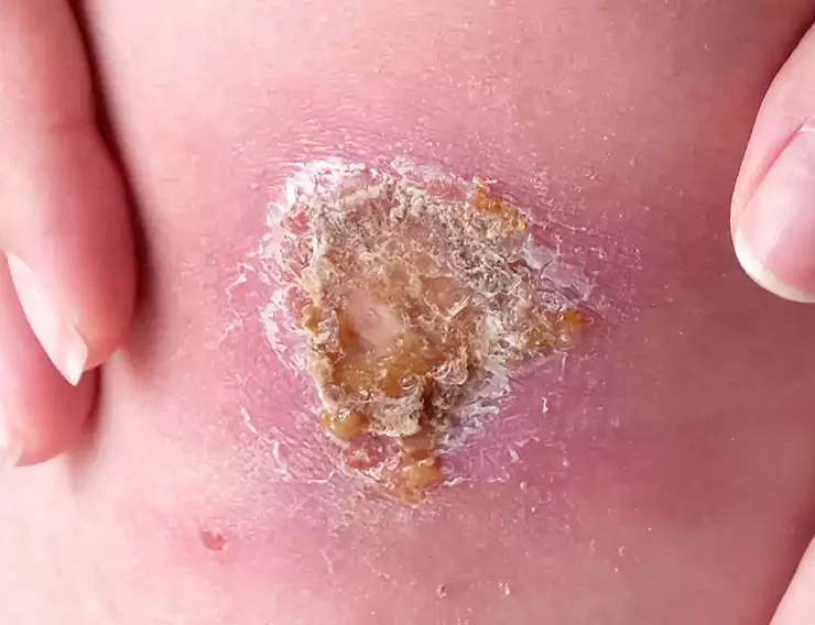 زخم خشک شده