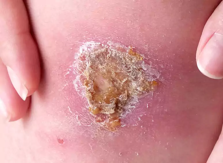 زخم خشک شده