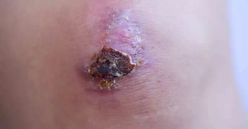 زخم خشک شده